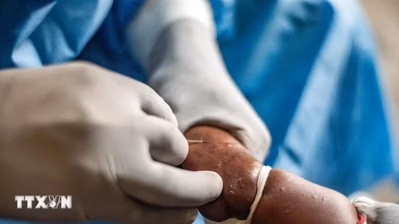 Trabajadores de la salud tratan a pacientes de viruela del mono en la ciudad de Goma, en la República Democrática del Congo, el 15 de agosto de 2024. (Fotografía: Xinhua/VNA)