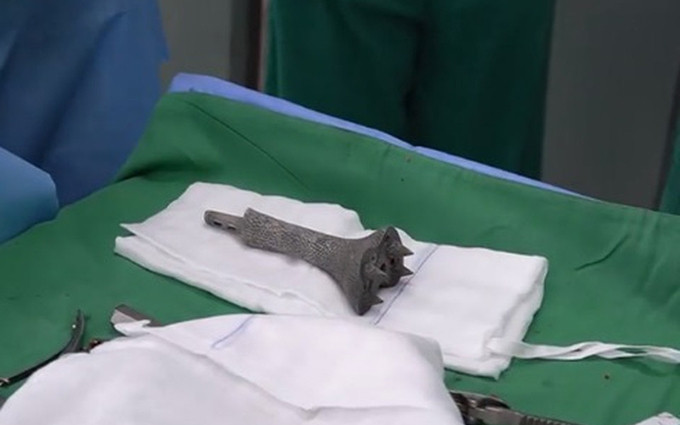 Vietnam realiza con éxito la cirugía de implante óseo para paciente con cáncer de hueso.