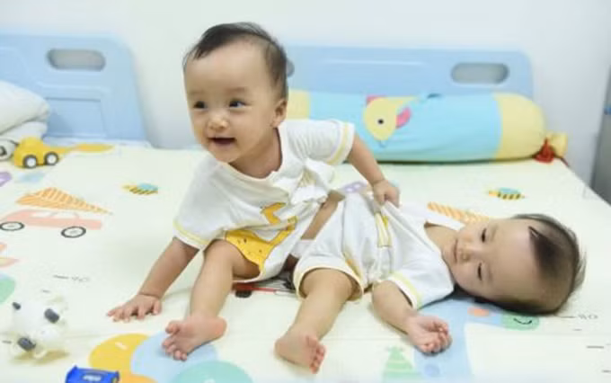 Las siamesas Truc Nhi y Dieu Nhi antes de la operación.