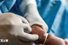 Trabajadores de la salud tratan a pacientes de viruela del mono en la ciudad de Goma, en la República Democrática del Congo, el 15 de agosto de 2024. (Fotografía: Xinhua/VNA)